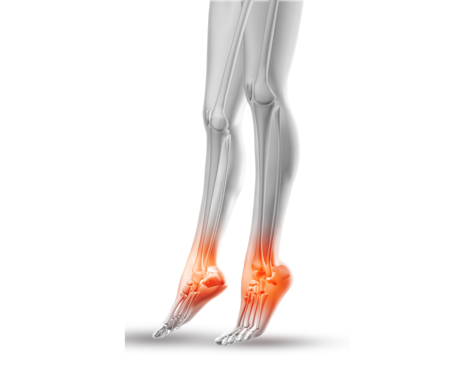 Tendinitis en el Talón de Aquiles